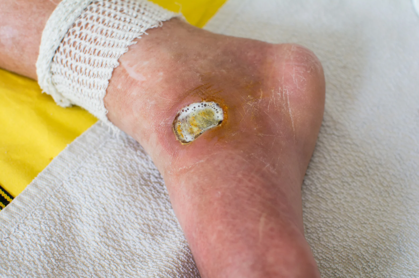 Orthopedic Treatment for Diabetic Gangrene