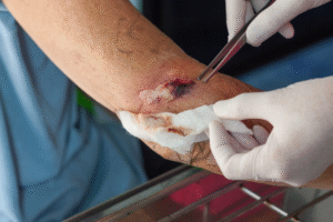 Advanced wound debridement Philippines
