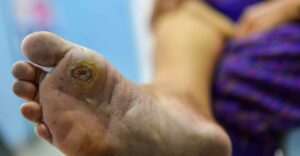 Comprehensive Care Approaches for Diabetic Foot Ulcer Management