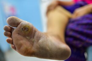 Orthopedic Treatment for Diabetic Gangrene Effective Approaches to Preserve Limb Health