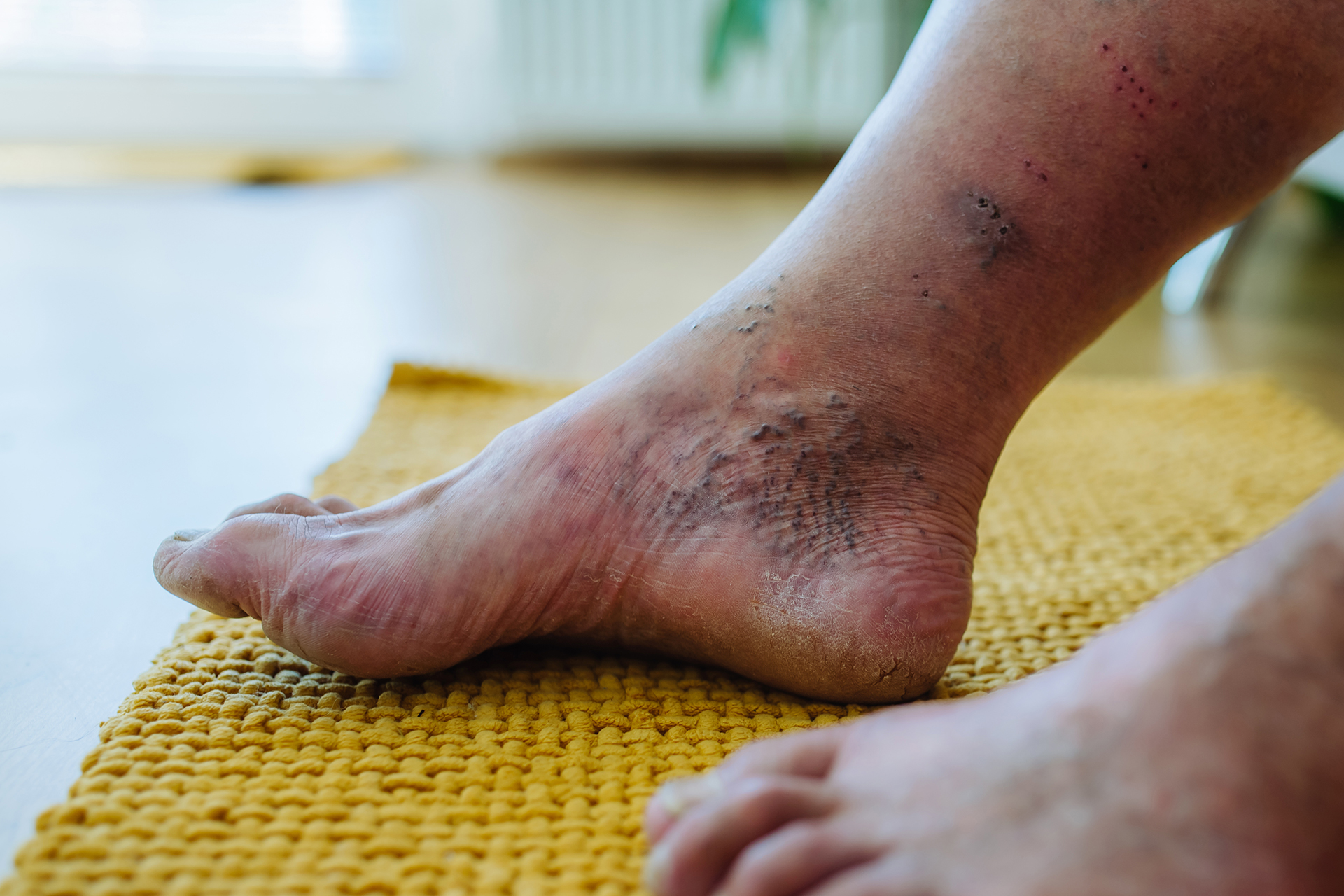 Effective Strategies for Comprehensive Diabetic Foot Ulcer Management