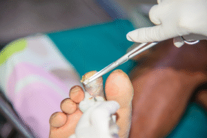 Orthopedic Treatment for Necrotic Foot Advanced Solutions for Healing and Limb Preservation