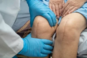 Total Knee Replacement A Comprehensive Guide to Restoring Mobility and Quality of Life